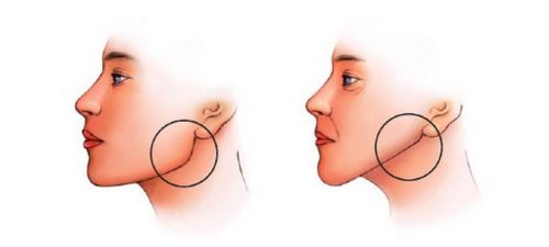 Как устранить холку и вернуть лицу красивый угол молодости (Игорь Атрощенко)